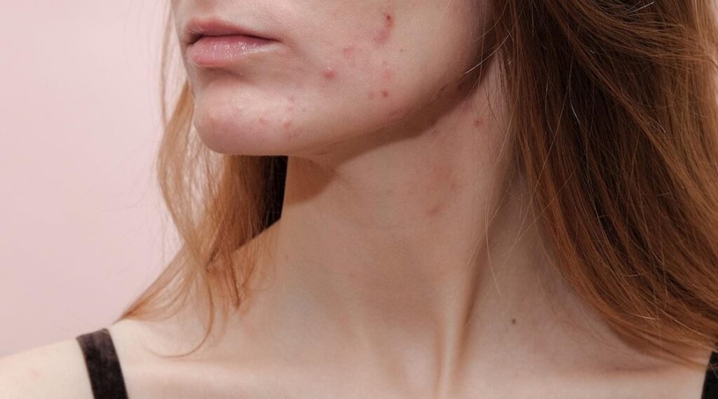 How to treat skin issues beautyhealthytoday