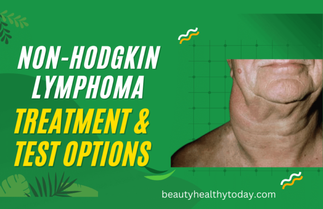 Best Non Hodgkin Lymphoma Treatment And Test Options 